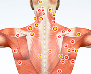 Trigger Point Injections